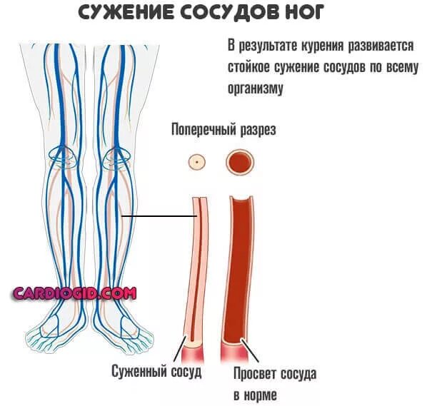 Атеросклероз бедра