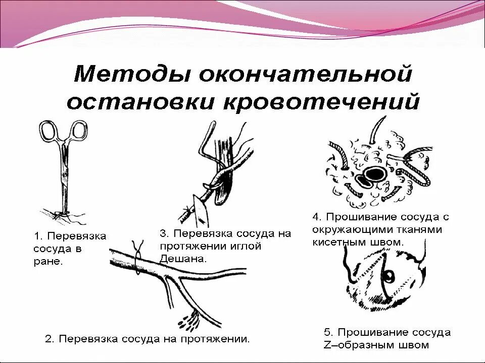 Механические и физические методы остановки кровотечения. Механический способ окончательной остановки кровотечения. Методы окончательной остановки кровотечения. Физические способы окончательной остановки кровотечения.