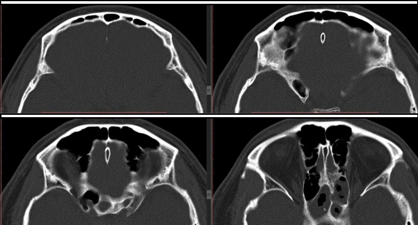 Признаки сфеноидита. Хронический сфеноидит на кт. Кт пазух носа сфеноидит.