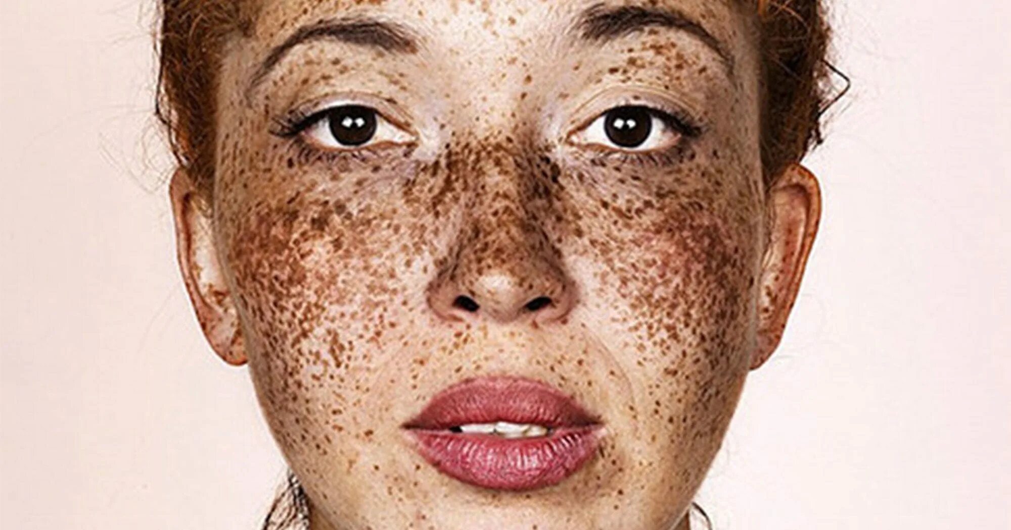 Freckles перевод. Лентиго, хлоазма, веснушки. Веснушки на лице.