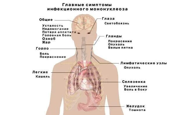 Мононуклеоз это. Инфекционный мононуклеоз симптомы. Вирусный мононуклеоз симптомы. Мононуклеоз проявления болезни. Симптомы инфекционного мононуклеоза симптомы.