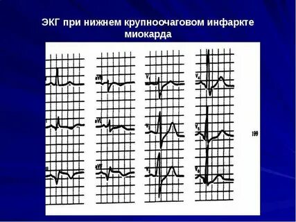 Мелкоочаговый инфаркт