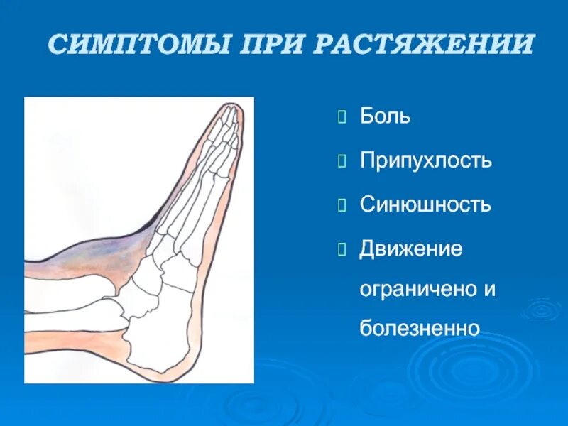 Ограниченный болезненный. Голеностопный сустав. Растяжение голеностопного сустава. Вывих голеностопного сустава первая.