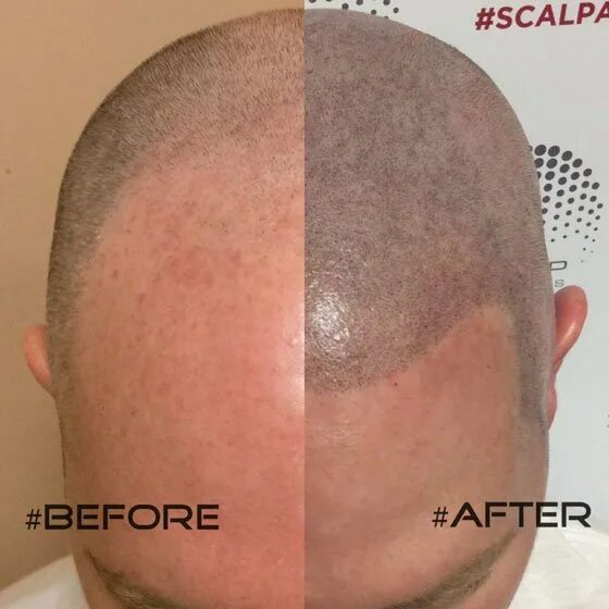 Клетчаточных пространств свода черепа. Грибок malassezia кожи головы. Скальп кожи головы. Скальп кожи головы. Трихопигментация головы.