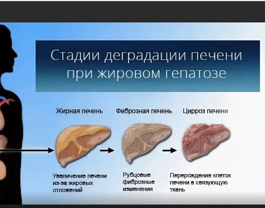 Какие лекарства принимать при жировом гепатозе