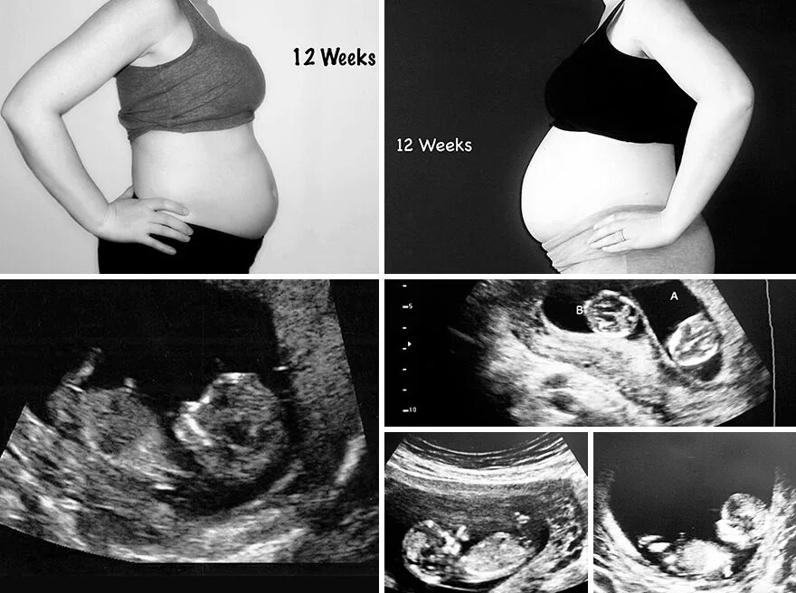 Размер живота на 12 неделе беременности двойней. Живот на 11 неделе беременности двойней. Живот на 12 неделе беременности двойней. Живот при беременности двойней 11 недель. Тянет живот на 11 неделе