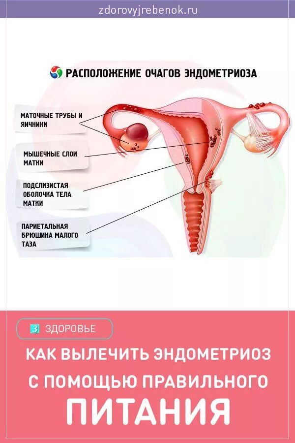 Рак матки психосоматика. Эндометриоз яичников психосоматика. Эндометриоз маточных труб.