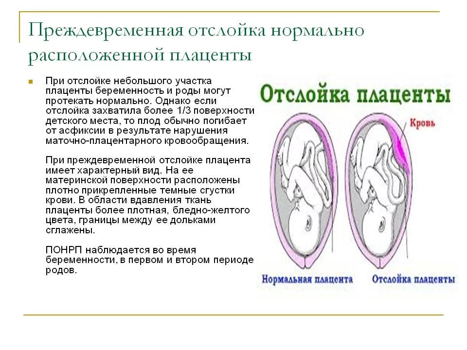 Отслойка нормально расположенной плаценты симптомы. Симптомы отслойки плаценты на 7 неделе беременности. Что такое плацента отслойки плаценты при беременности. Отслойка плаценты при беременности в 1 триместре. 41 неделя тянет