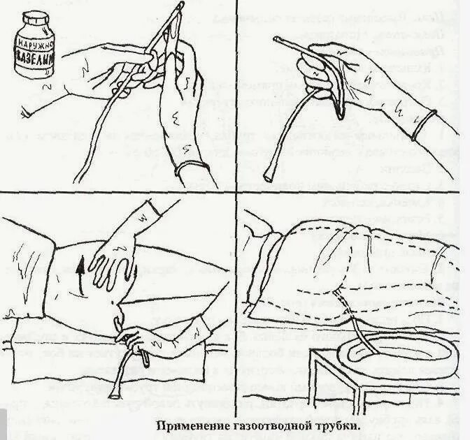 Опорожнение после масляной клизмы. Очистительная клизма алгоритм. Введение газоотводной трубки новорожденному. Газоотводная трубка в прямой кишке. Постановка газоотводной трубки манипуляция.