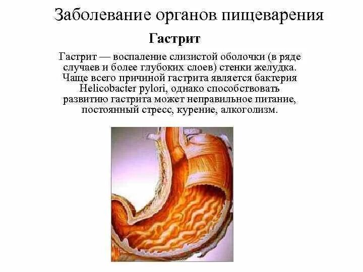 Заболевания жкт сообщение. Причины и профилактика заболеваний пищеварительной системы. Заболевания органов пищеварения гастрит. Реферат по биологии 8 класс на тему заболевания органов пищеварения. Сообщение о болезнях органов пищеварительной системы.