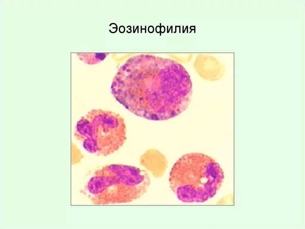 Эозинофилия мкб. Эозинофилия. эозинофилия крови. эозинофильные включения.