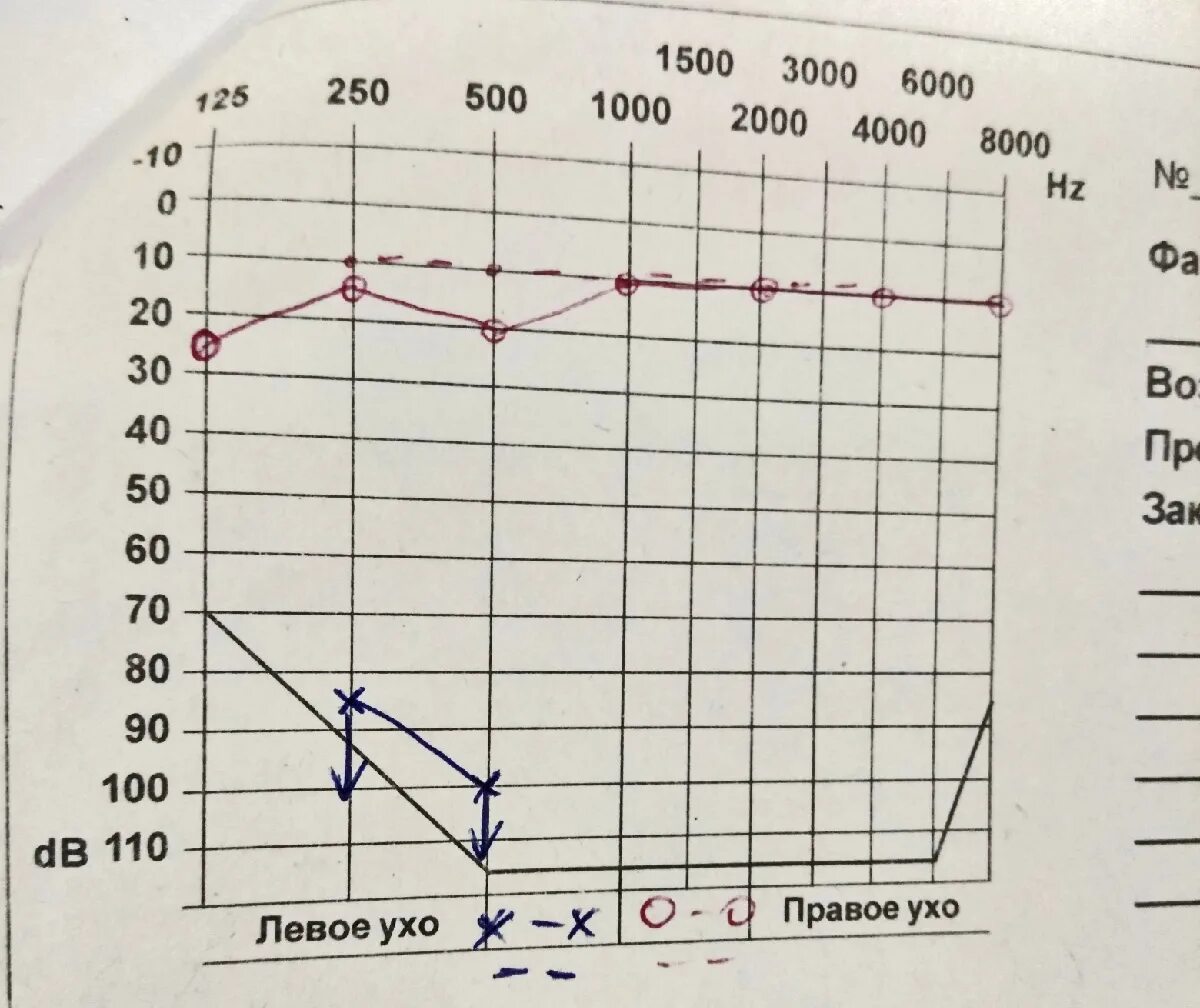 Аудиограммы кондуктивной тугоухости. Острая сенсоневральная тугоухость аудиограмма. Нейросенсорная тугоухость аудиограмма. Аудиометрия при кондуктивной тугоухости. Аудиограмма ребенку