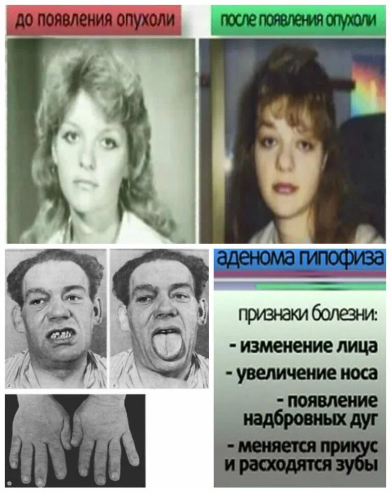Гормонально активной аденоме