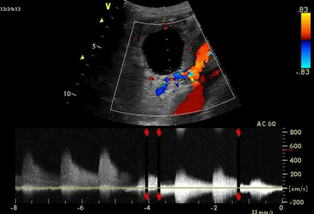 Как делают доплер. Допплеровская ультразвуковая допплерография почек.. Доплер УЗИ сосудов почек. УЗИ сосудов почки допплер. УЗИ допплерометрия.