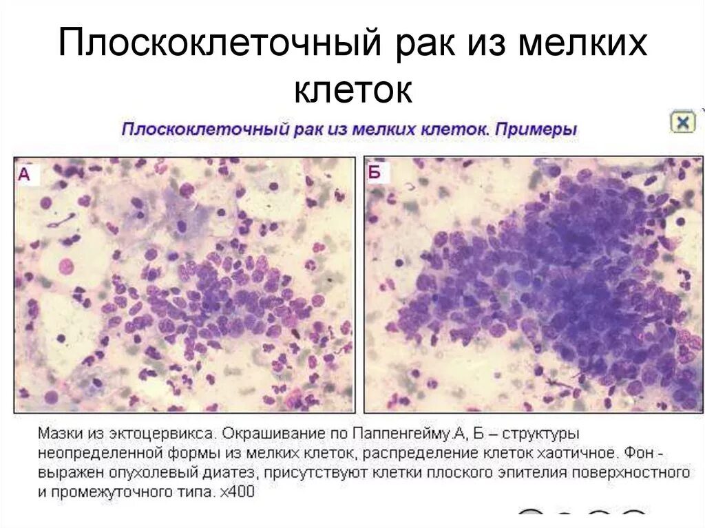 Реактивные изменения в цитологическом. Цитология карциномы кожи. Гиперплазия эндометрия цитология. Плоскоклеточная карцинома шейки матки гистология. Плоскоклеточная карцинома цитология.