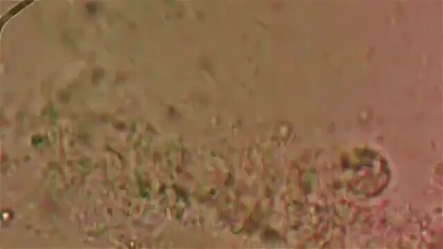 гной под микроскопом. гной под микроскопом. гной под микроскопом. гонококки при микроскопии. как выглядит радиация под микроскопом.