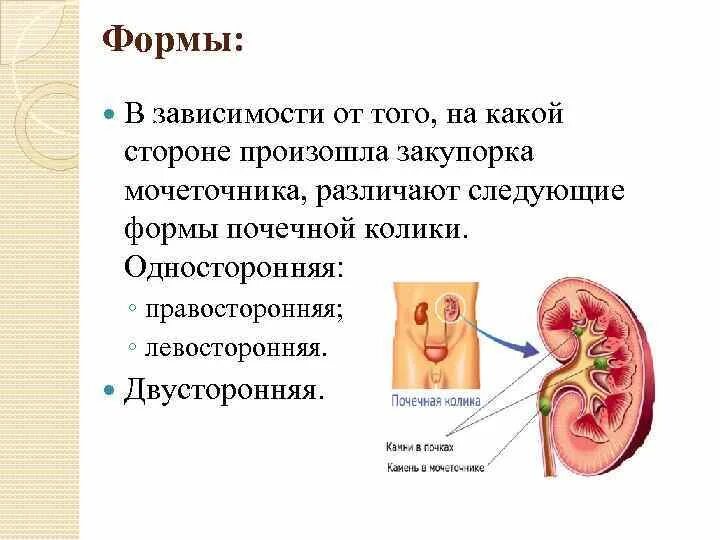 Обструкция мочеточника. Почечная колика. Двухсторонняя почечная колика.