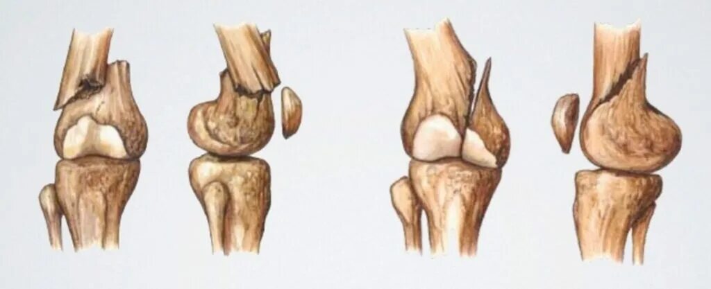Повреждение мыщелка. Перелом дистального метафиза бедренной кости. Переломы мыщелков бедренной кости классификация. Перелом мыщелка бедренной кости. Переломы мыщелков бедренной кости.