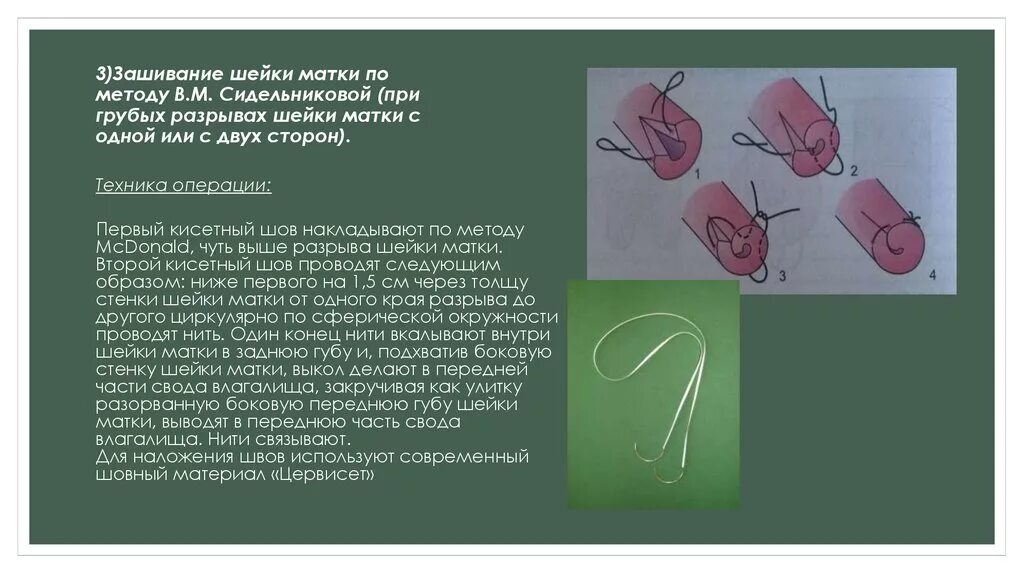 Операция опущения шейки. Операция по наложению шва на шейку матки при беременности. Наложение швов на шейку матки при беременности при ИЦН. Беременность после наложения швов на шейку матки. Операция зашить шейку матки.