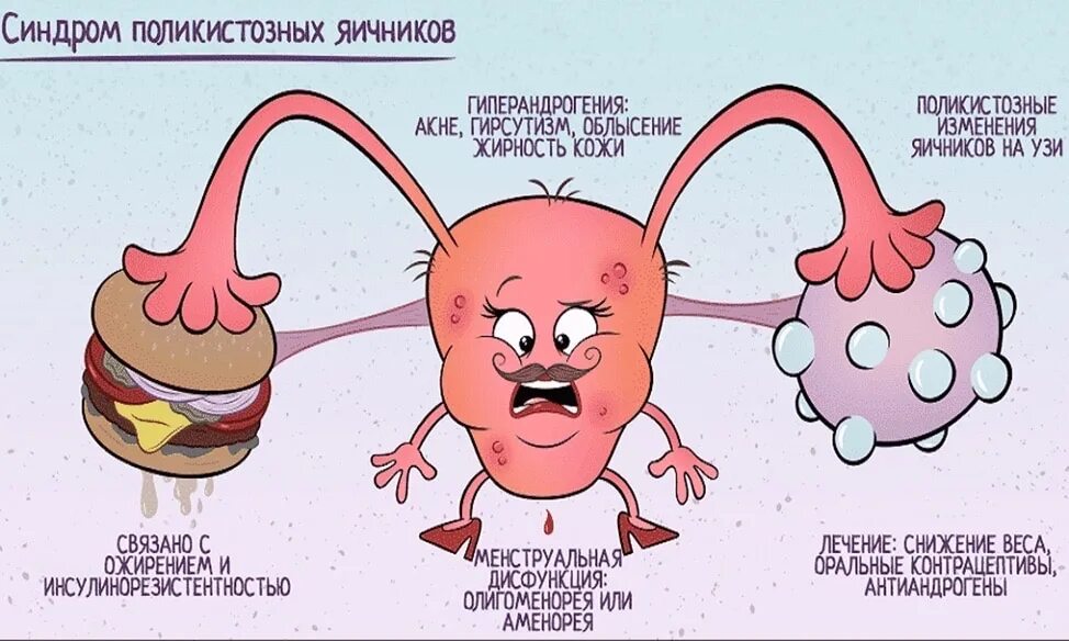 Поликистозные яичники лечение. Поликистозная структура яичников. Синдром поликистоза яичников.