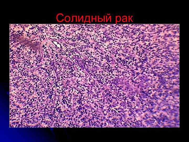 Рак солидного строения