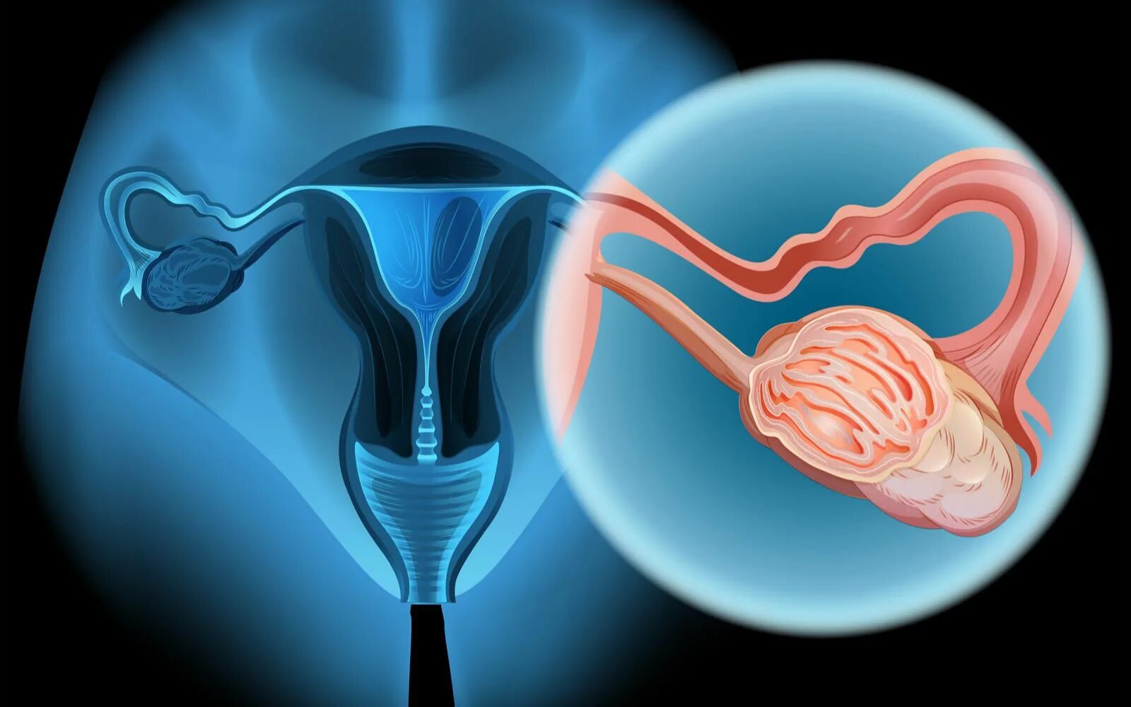 Ovarian cancer