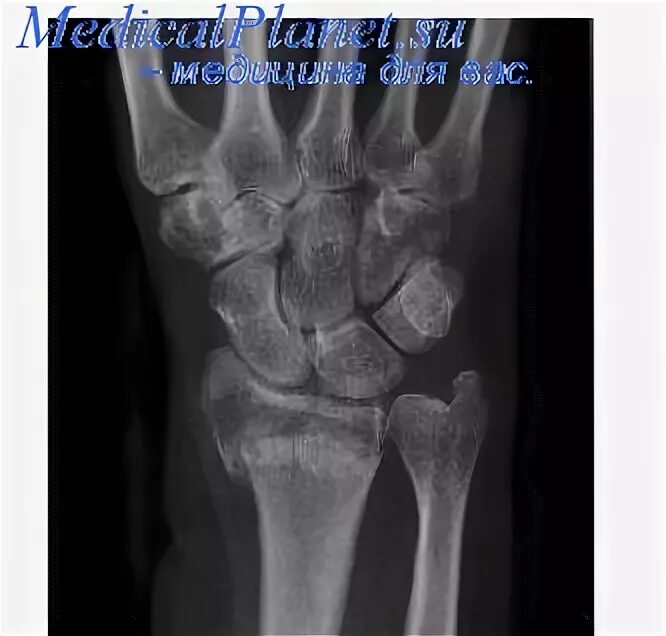 Перилунарный вывих кисти вправление. Перилунарный вывих кисти характеризуется. Вывих локтевого сустава мкб. Ладьевидная кость лучезапястного сустава. Растяжение лучезапястного сустава.