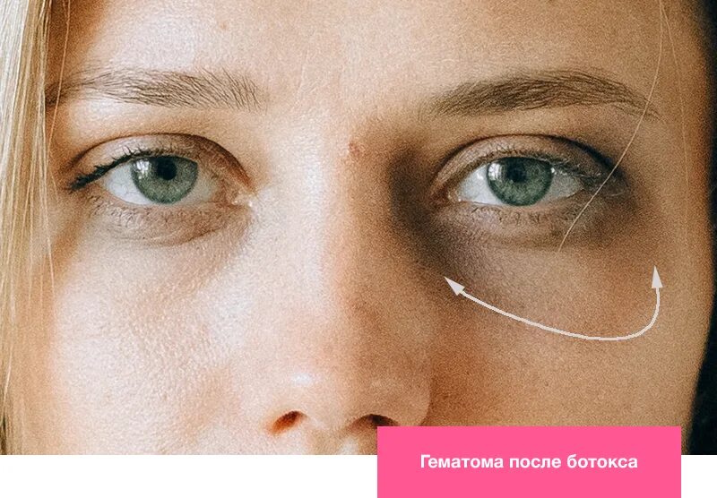 Синяк глаз ботокса