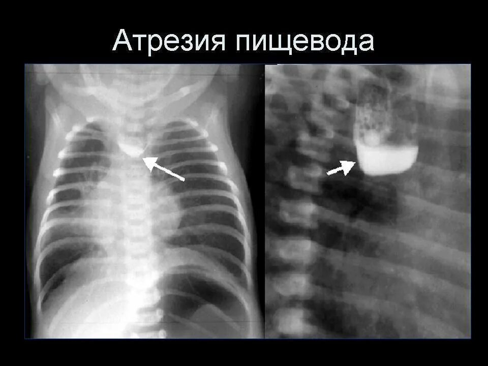 Трахеопищеводный свищ рентген. Атрезия пищевода рентген. Рентген при атрезии пищевода. Атрезия пищевода у детей рентген. Слепой пищевод