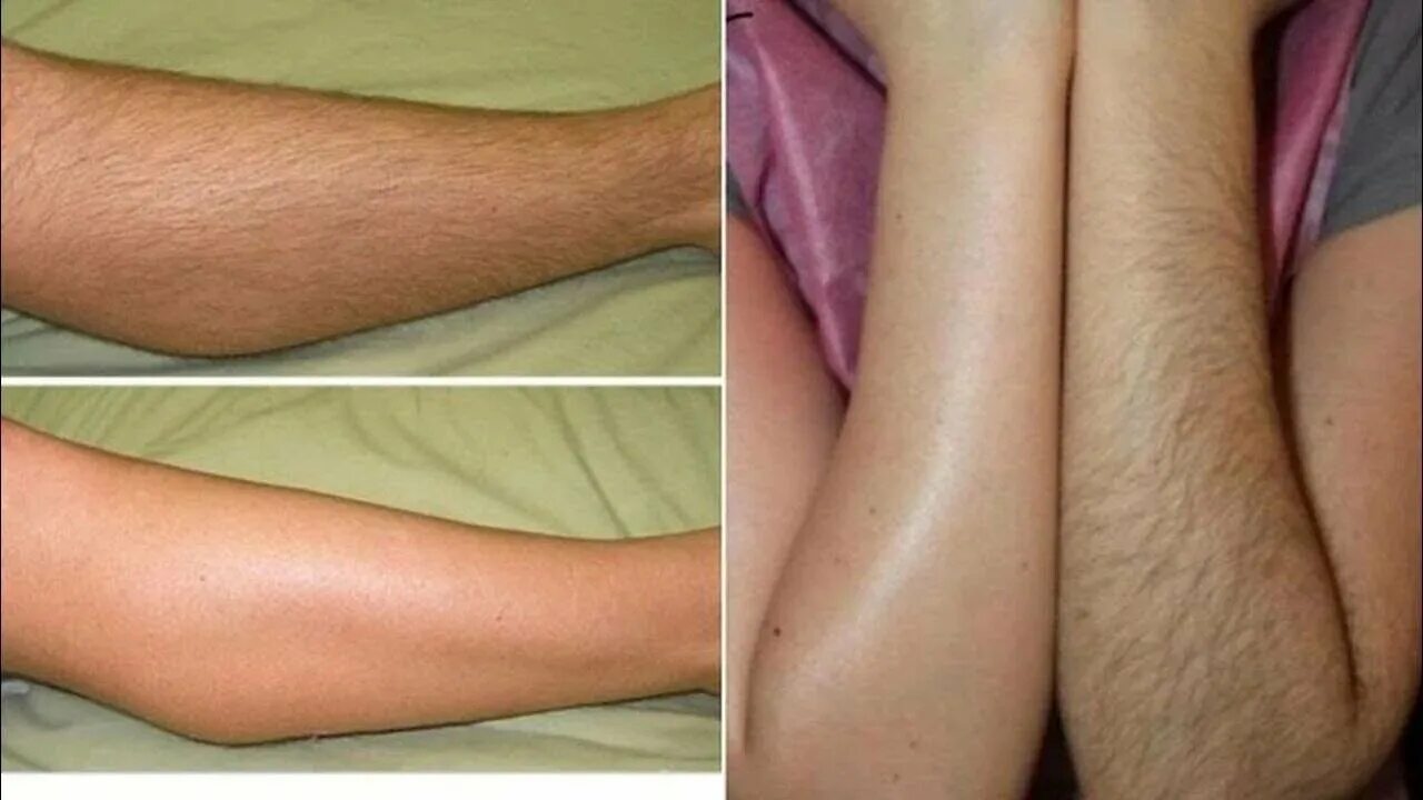 Шугаринг рук. Фотоэпиляция глубокое бикини. Депиляция воском раздражение. Депиляция скинс глубокое бикини. Волосы после бритвы и шугаринга.