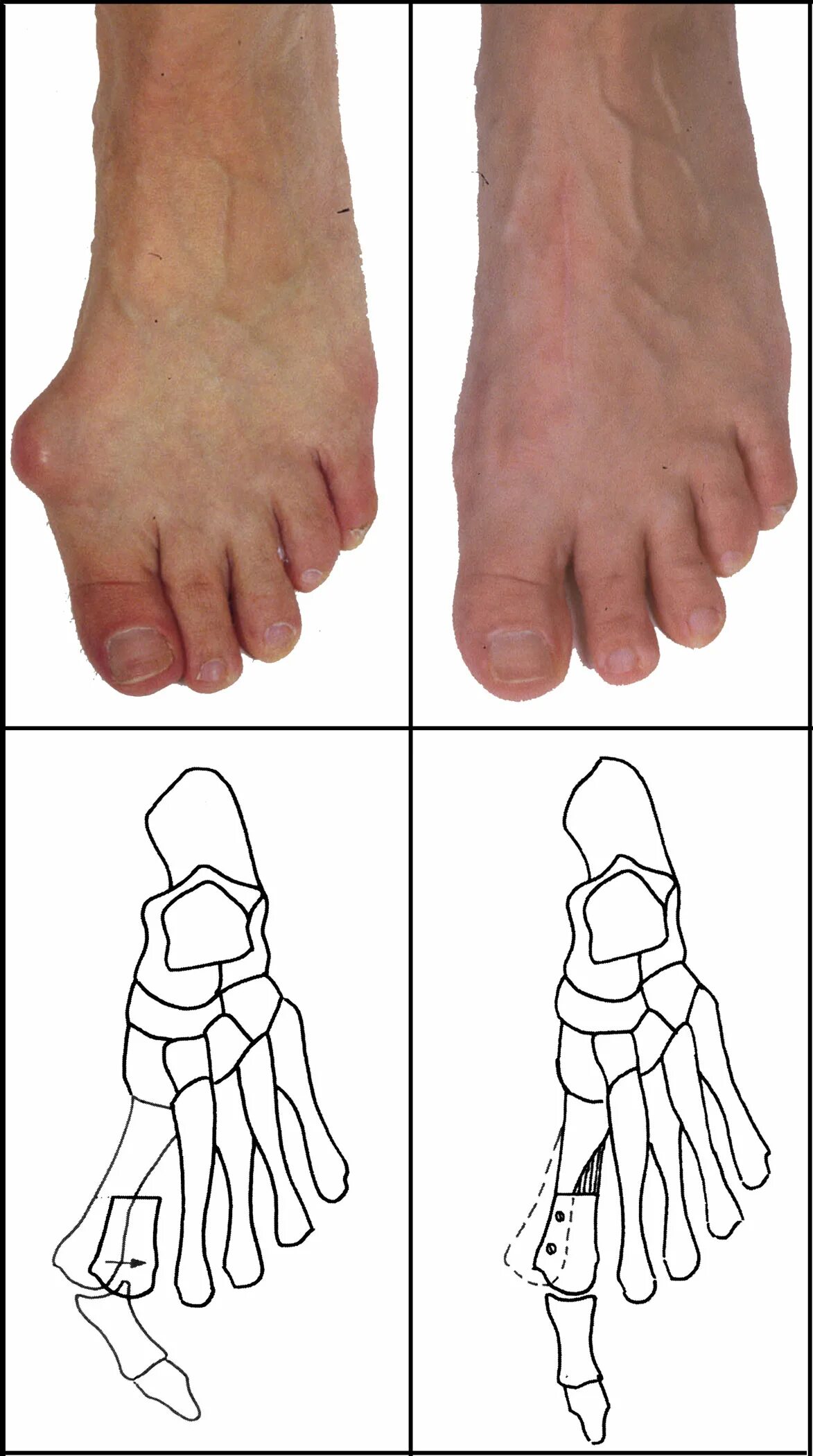 Растущая кость на большом пальце. Вальгусная деформация косточки. Вальгусная деформация большого пальца операция. Кострчка на большомплце. Кости большого пальца ноги.