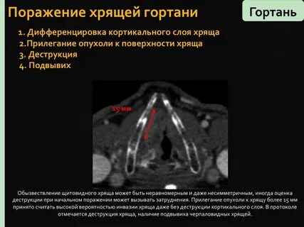 Симптомы отека гортани