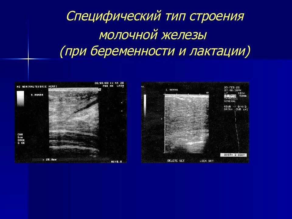 Записаться на узи молочной железы. Структура молочной железы на УЗИ. Строение молочной железы на УЗИ. Тип строения молочных желез УЗИ. Молочная железа УЗИ анатомия.