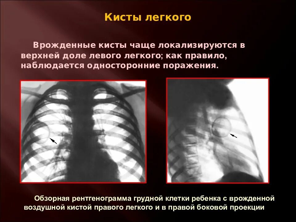 Врожденная киста легкого рентген. Воздушная киста рентген. Бронхогенные кисты рентген. Образование легких неуточненное