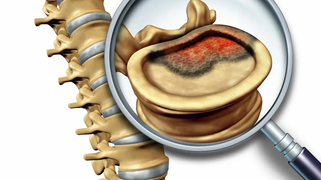 Позвоночник припухлость