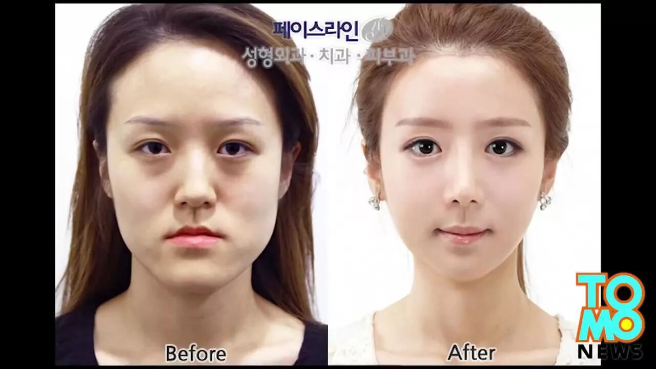 Пластическая операция со скольки лет. Кореянки до и после пластики глаз. Пластическая хирургия в Корее. Пластические операции в Корее. Корейская пластическая хирургия.