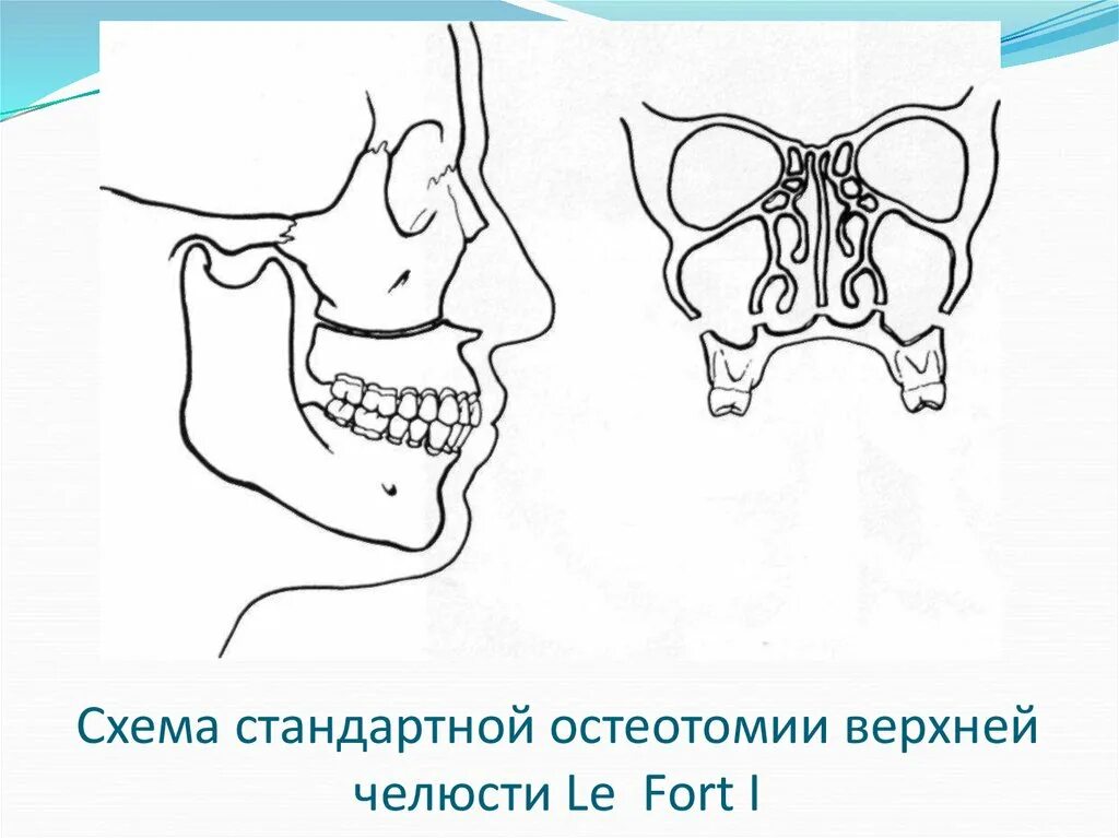 Остеотомия нижней челюсти операция. Межкортикальная остеотомия нижней. Фронтальный отдел верхней челюсти это. Остеотомию верхней и нижней. Операция остеотомия верхней челюсти.