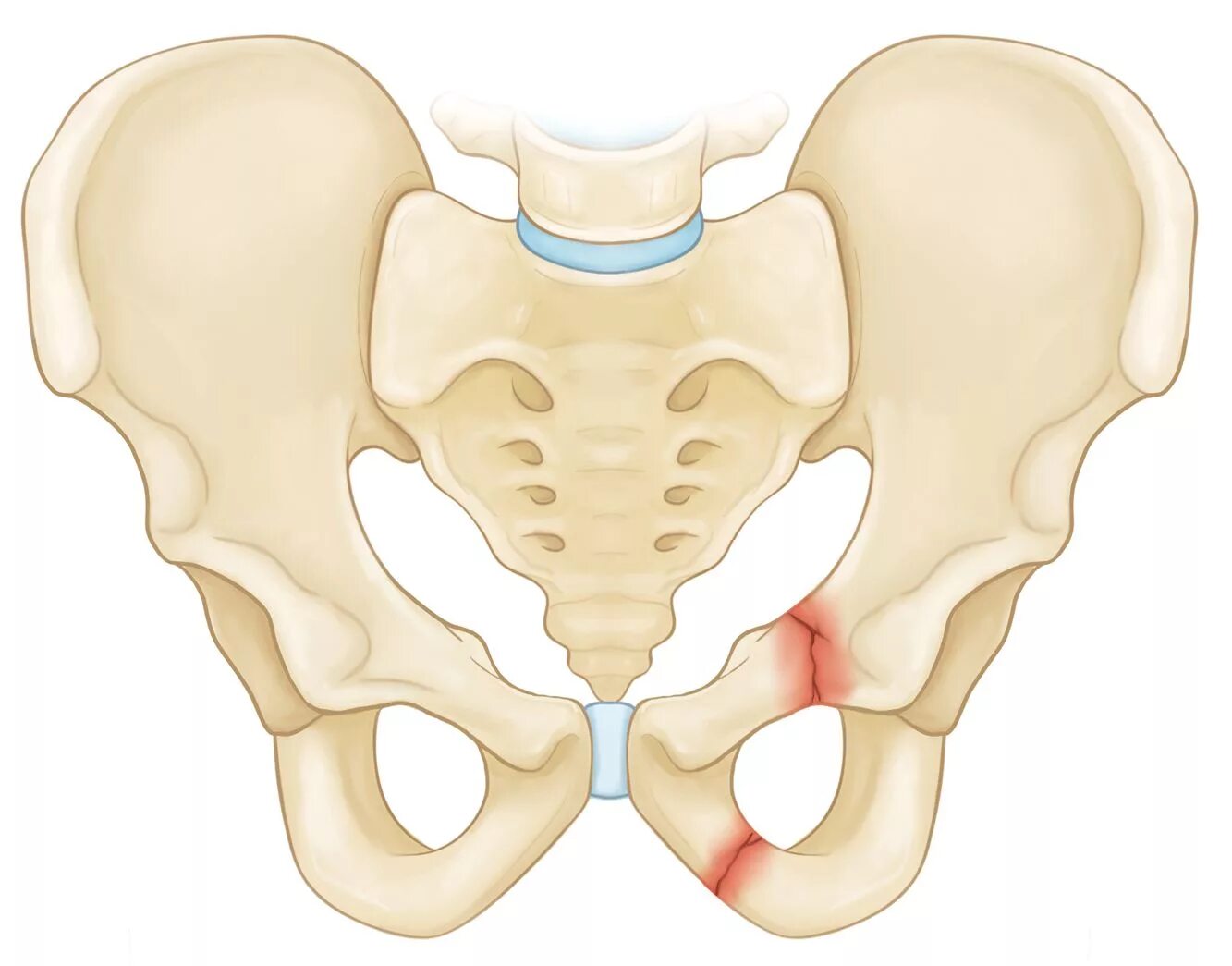 Подвздошная кость отдел. Передом ладонной кости. Лонная кость таза перелом анатомия. Перелом лонной кости таза. Лонная кость таза перелом.