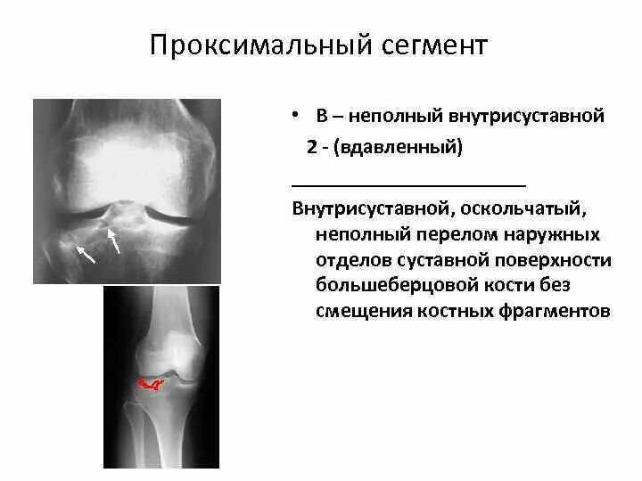 Перелом проксимального отдела большеберцовой кости рентген. Переломы проксимального отдела большеберцовой кости классификация. Перелом наружного мыщелка большеберцовой кости. Перелом наружного мыщелка большеберцовой кости рентген.