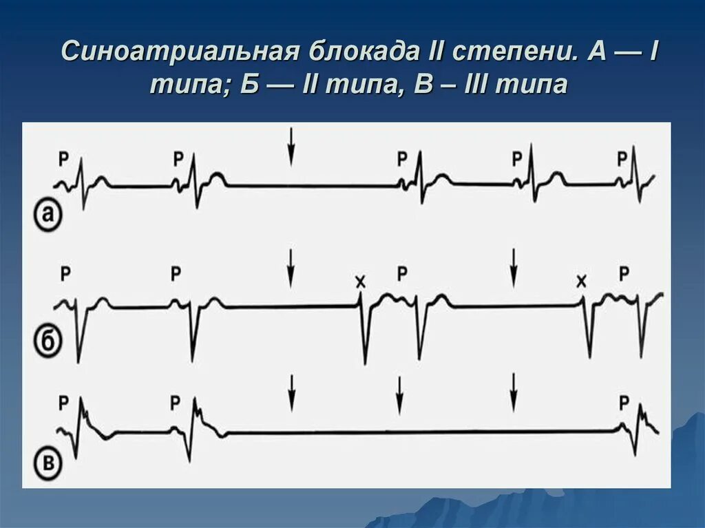 Са блокада типы. Синоатриальная блокада Мобитц 1 ЭКГ. ЭКГ при синоатриальной блокаде 2 степени Тип 1. Синоаурикулярная блокада 2 степени 1 типа. Синоатриальная блокада 2 степени на ЭКГ.