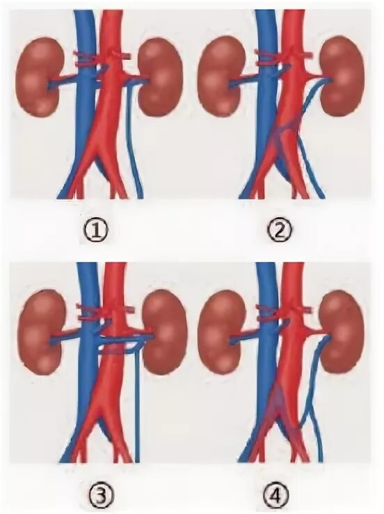Изменение левой почки. Ретроаортальная левая почечная Вена. Аномалии почечных артерий. Добавачно почечная Вена. Аномалия левой почечной вены.