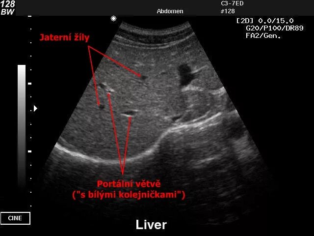 Ультразвуковое исследование при беременности раннего срока. Узи по беременности на ранних сроках. Пол ребенка на узи. Узи пол ребенка девочка. Неразвивающаяся беременность.