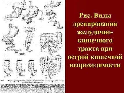 Кишечная непроходимость мкб