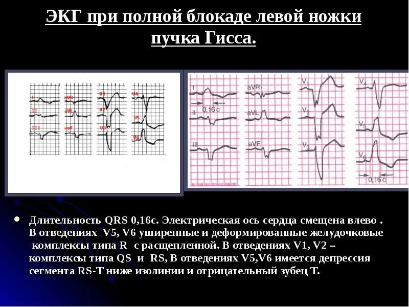 Комплекс блокада. ЭОС при полной блокаде левой ножки. QRS v5 v6. ЭКГ при полной блокаде. ЭКГ при полной блокаде левой ножки.