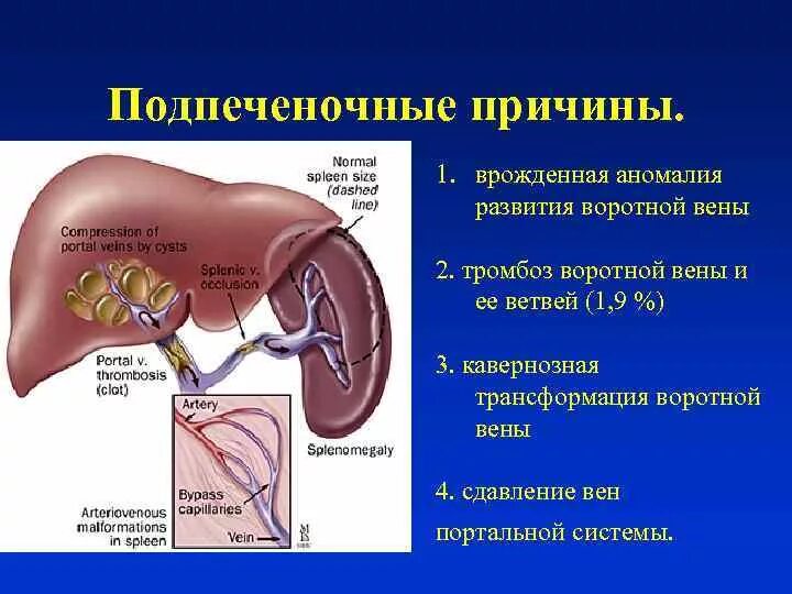 Тромб в печени