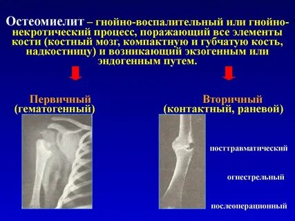 Острый остеомиелит признаки