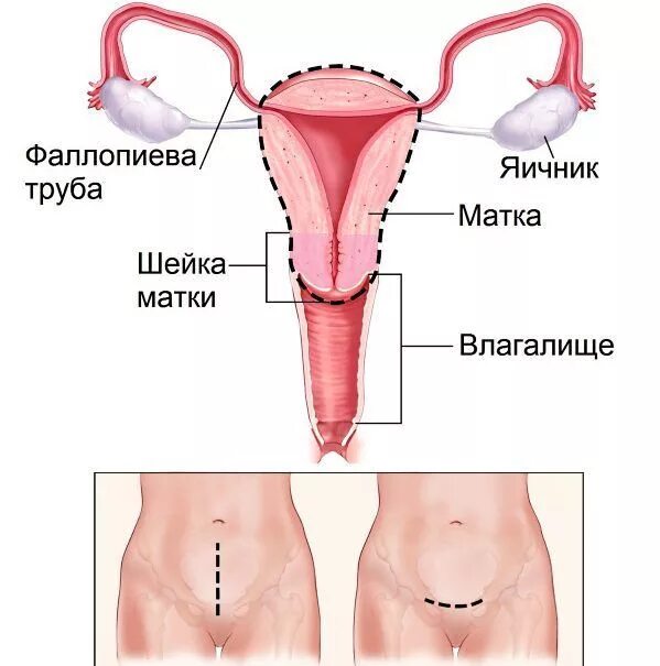 Гистерэктомия с придатками