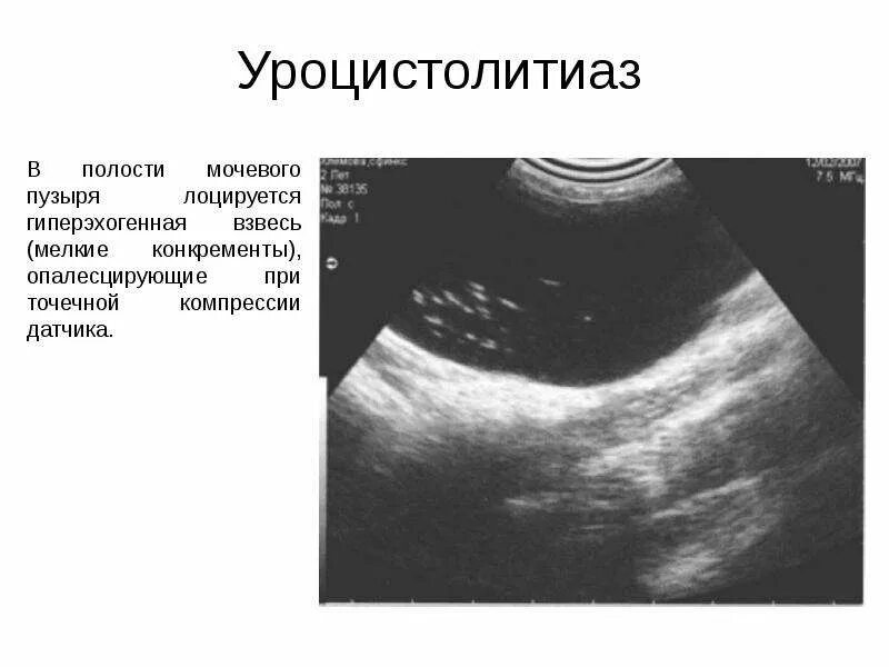 Гиперэхогенные включения в желчном пузыре. Гиперэхогенная взвесь в мочевом пузыре на УЗИ. Гиперэхогенный желчный пузырь УЗИ. Взвесь в желчном пузыре на УЗИ. УЗИ мочевого пузыря аппарат.