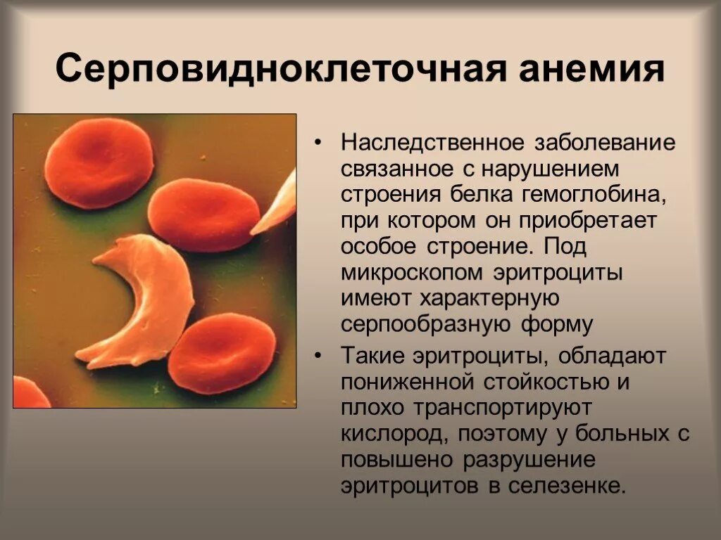 Ген заболевание крови. Гематологические критерии серповидноклеточной анемии. Серповидноклеточная анемия эритроциты форма. Серповидноклеточная анемия (гемоглобинопатия). Серповидноклеточная анемия плейотропия.