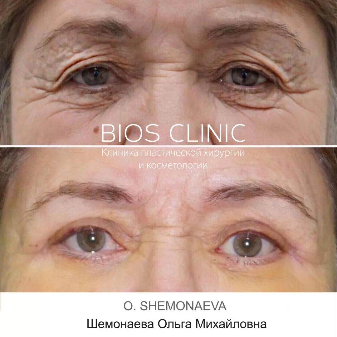 Блефаропластика (пластика нижних век). Квадрилатеральная блефаропластика что это такое. Неудачная блефаропластика нижних век. Трансконъюктивальная блефаропластика реабилитация. Неудачная блефаропластика верхних век.